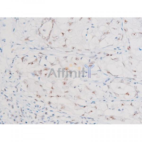 Phospho-NF-kB p65 (Ser281) Antibody - AF3393 at 1/200 staining Human liver cancer tissue sections by IHC-P.